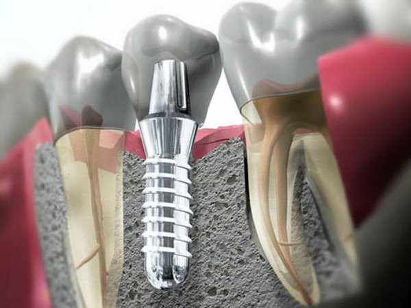 Что такое имплантация зубов и как ее делают?
