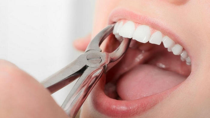 Какие действия следует предпринимать после удаления зуба?