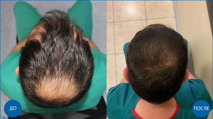Пересадка волос в Турции бесшовным методом FUE: значимые аспекты и преимущества