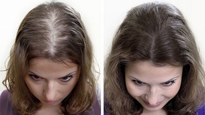 Регейн – эффективное средство для роста волос для женщин