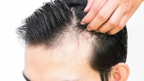 Основні причини випадіння волосся