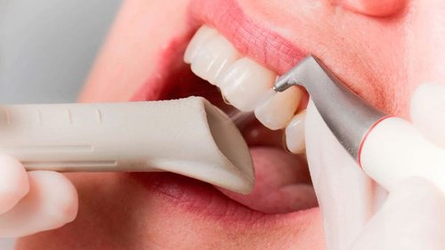 Польза и особенности профессиональной чистки зубов