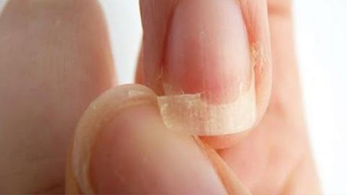 Когда ломаются и слоятся ногти — организм просит о помощи