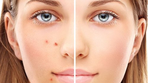 От гормонов до одежды: причины акне на разных участках лица и теле