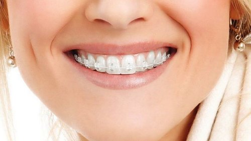 Разговор о брекетах: необходимость или прихоть?