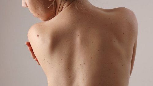 Самодиагностика родинок: как это делать и на что нужно обратить внимание