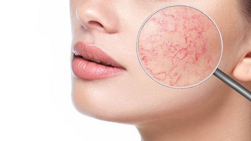 Купероз на лице: как предотвратить и возможно ли избавиться