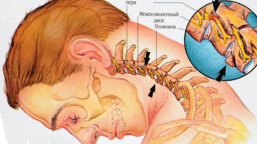 Остеохондроз. 7 простых правил, которые помогут вам сохранить спину здоровой