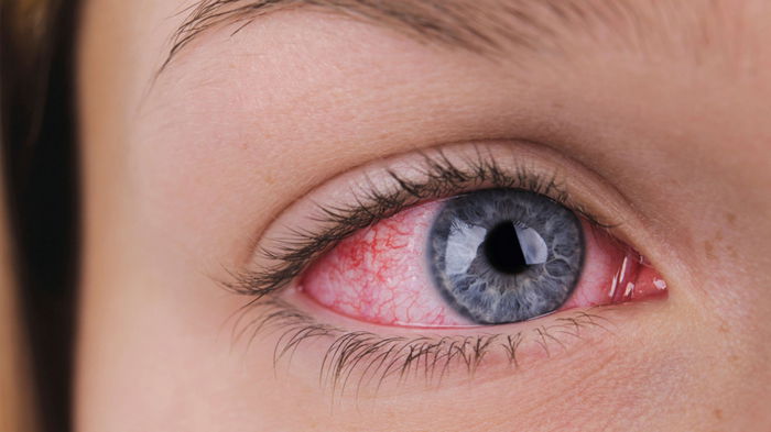 Почему краснеют глаза: основные причины