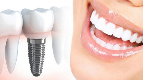 Стоматолог рассказал, кому не стоит ставить импланты зубов