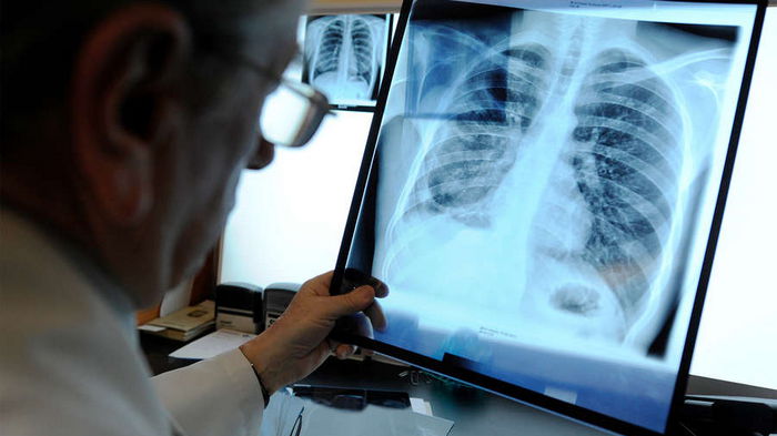 11 симптомов туберкулёза, о которых должны знать все