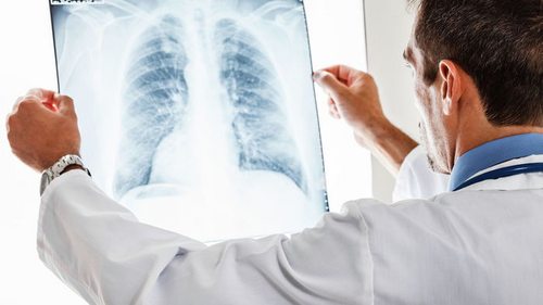 Что такое пневмония и в чем коварность этого заболевания