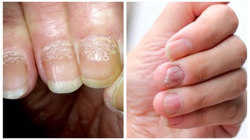 5 натуральных средств от псориаза ногтей