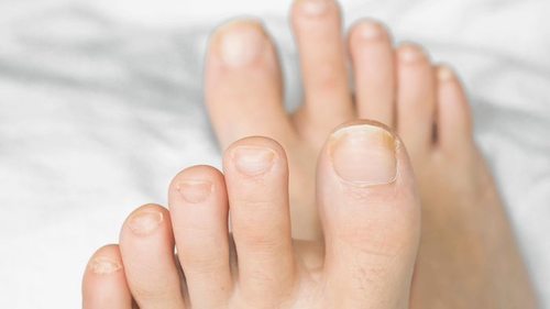 Грибок ногтя: как и чем лечить