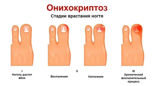 онихокриптоз стадии врастания ногтя