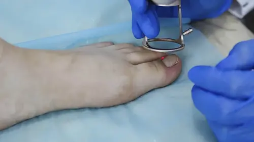 удаление вросшего ногтя