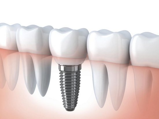 Имплантация зубов на место утраченных — залог хорошего здоровья