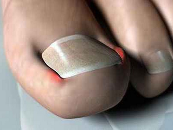 Вросшие ногти — причины и лечение народными средствами