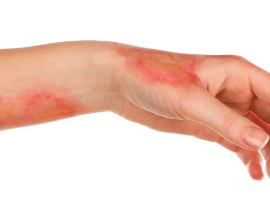 Лечение химического ожога кожи зависит от степени поражения