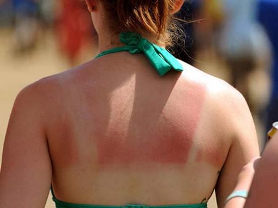 Что делать, если кожа обгорела на солнце?