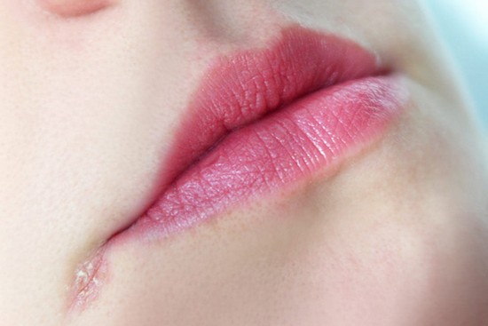 Неприятные заеды в уголках рта: причины и лечение