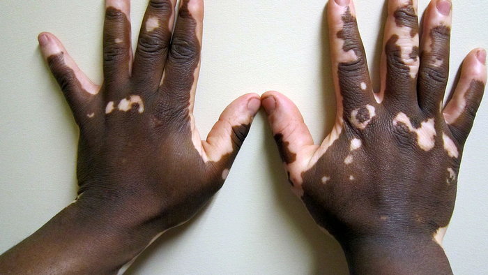 Ученые объяснили происхождение белых пятен на коже